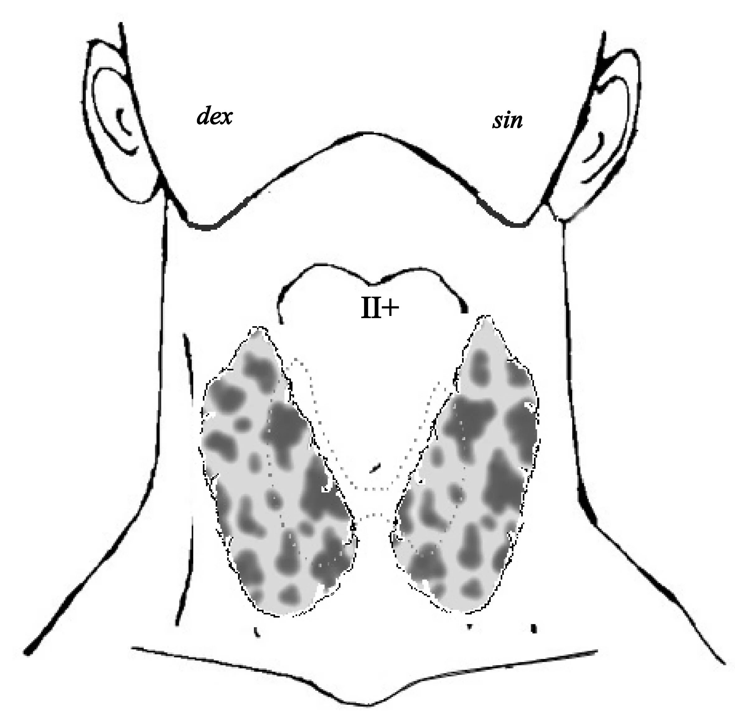 Диффузно-Узловой зоб токсический щитовидной железы. Токсический зоб щитовидка. Диффузный эутиреоидный зоб. Эндемический (диффузный эутиреоидный) зоб.