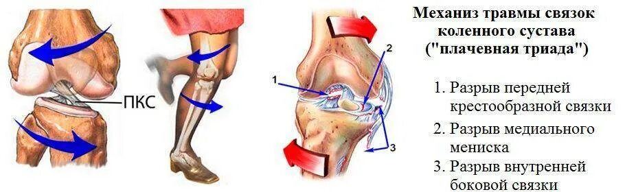 Повреждение коленной связки симптомы. Механизм повреждения мениска колена. Разрыв связок ПКС коленного сустава коленный сустав. Операция на повреждение связок коленного сустава.
