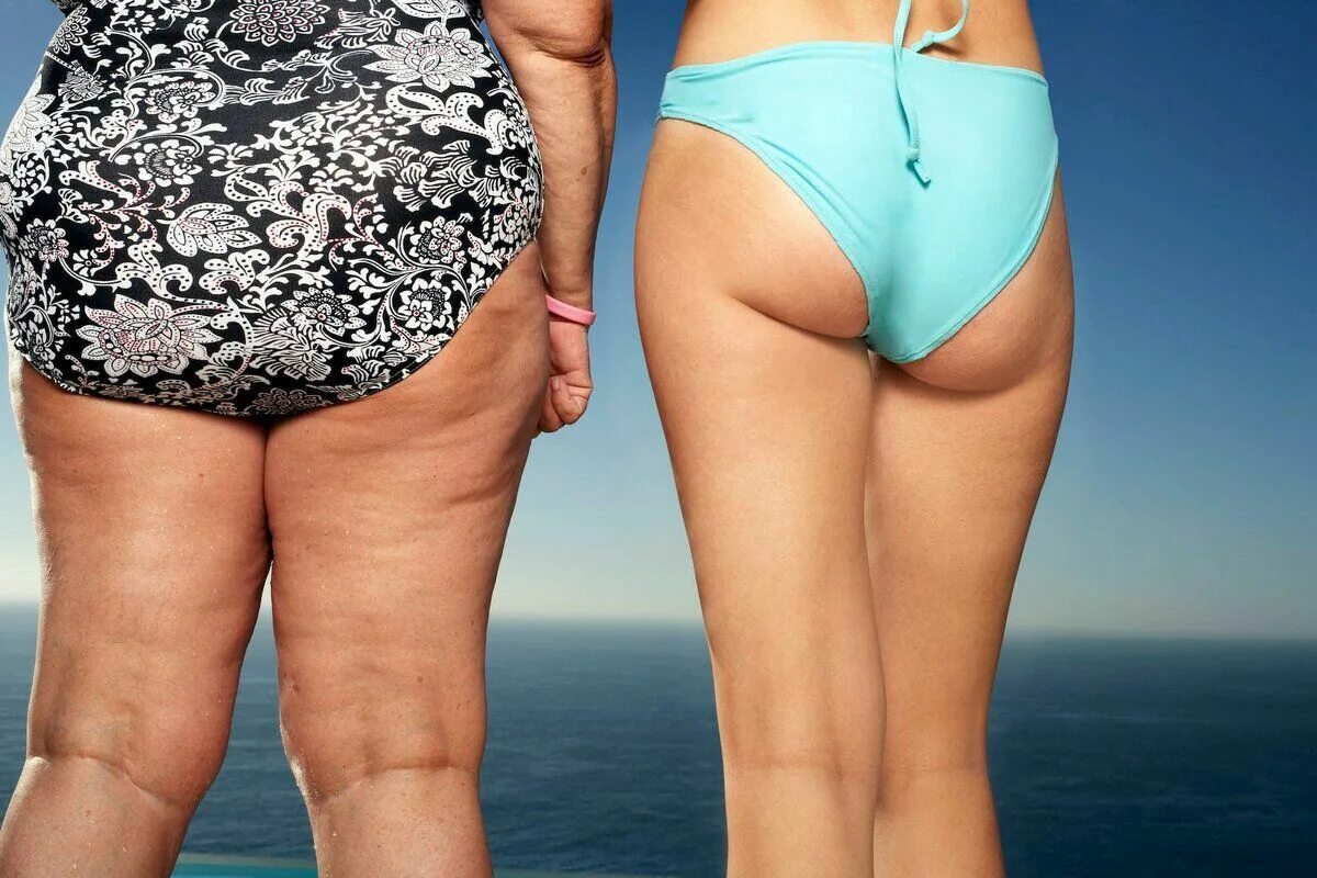 Холли берри целлюлит. Целлюлит у девушек. Стрии на бедрах и ягодицах. Красивое тело без целлюлита. Целлюлит у девушек.