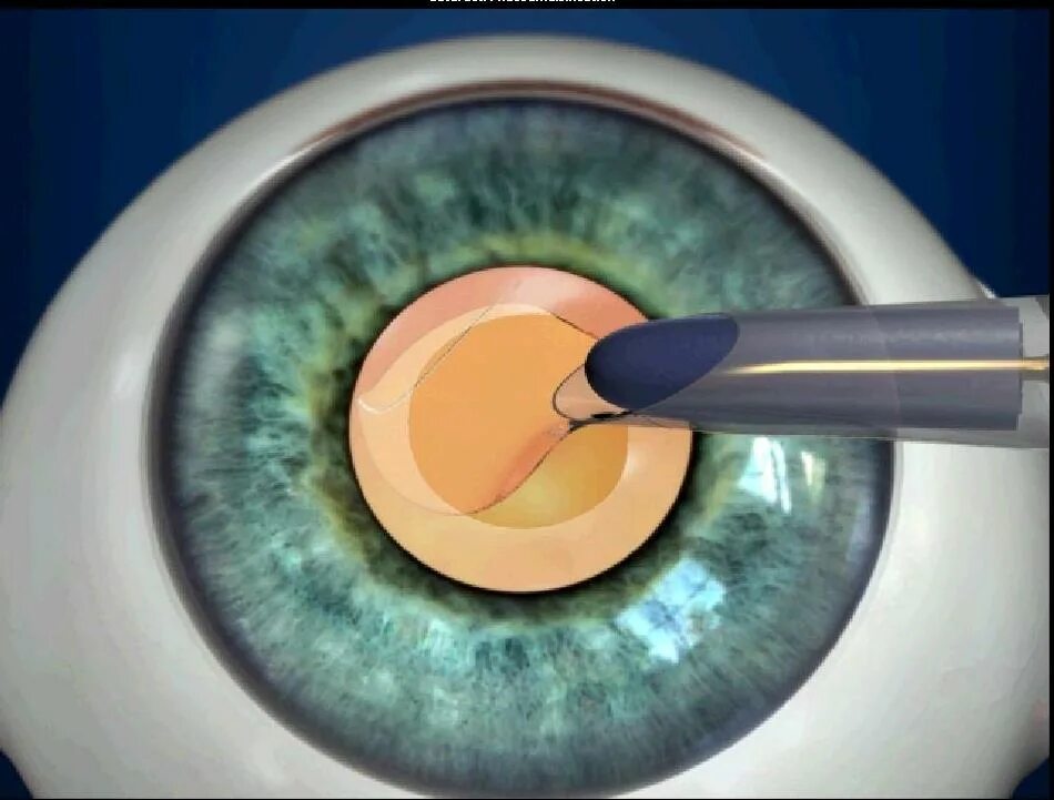Баня после катаракты. Факоэмульсификация катаракты. Факоэмульсификация катаракты с имплантацией ИОЛ. Ультразвуковая рукоятка для факоэмульсификации.