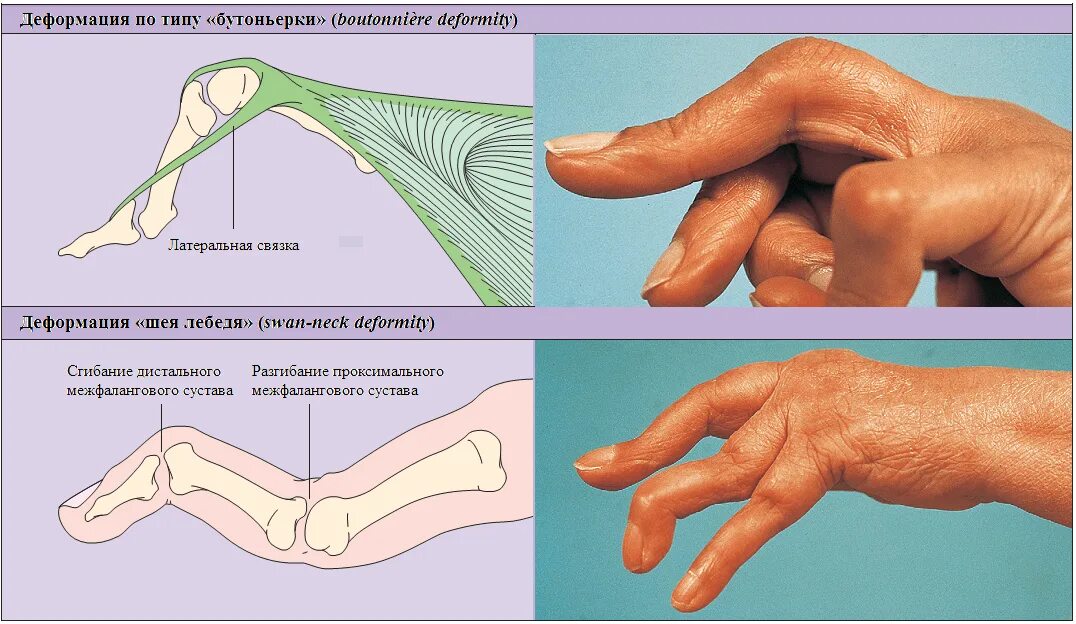 Больно разогнуть палец. Шея лебедя ревматоидный артрит. Контрактура при ревматоидном артрите. Ревматоидный артрит деформация кисти. Разрыв сухожилий разгибателей кисти.