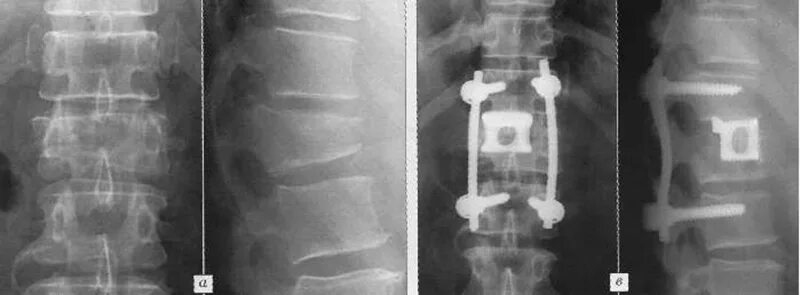Операция на позвоночник сколько времени. Рентген при компрессионном переломе позвоночника. Компрессионный перелом позвоночника l4,l5. Компрессионный перелом позвоночника th11-l1. Что такое компрессионный перелом позвонка клиновидный l 1.