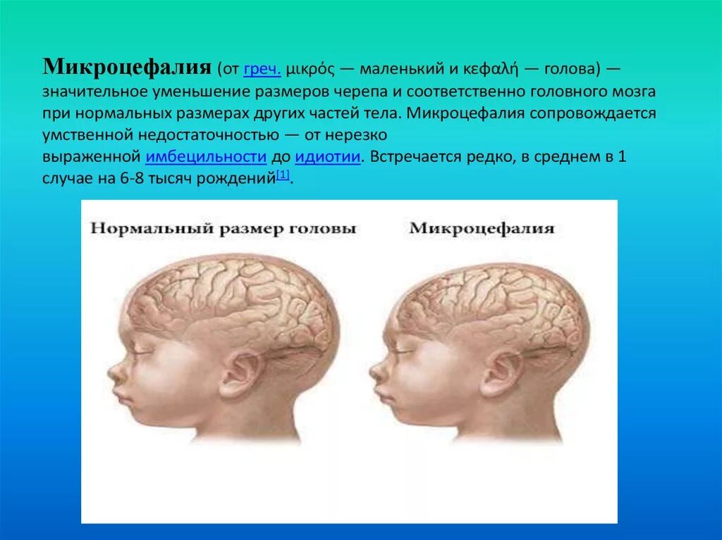 Микроцефалия причины. Микроцефалия форма черепа. Череп микроцефальной формы. Микроцефалия головного мозга у ребенка. Микроцефалия и макроцефалия это.