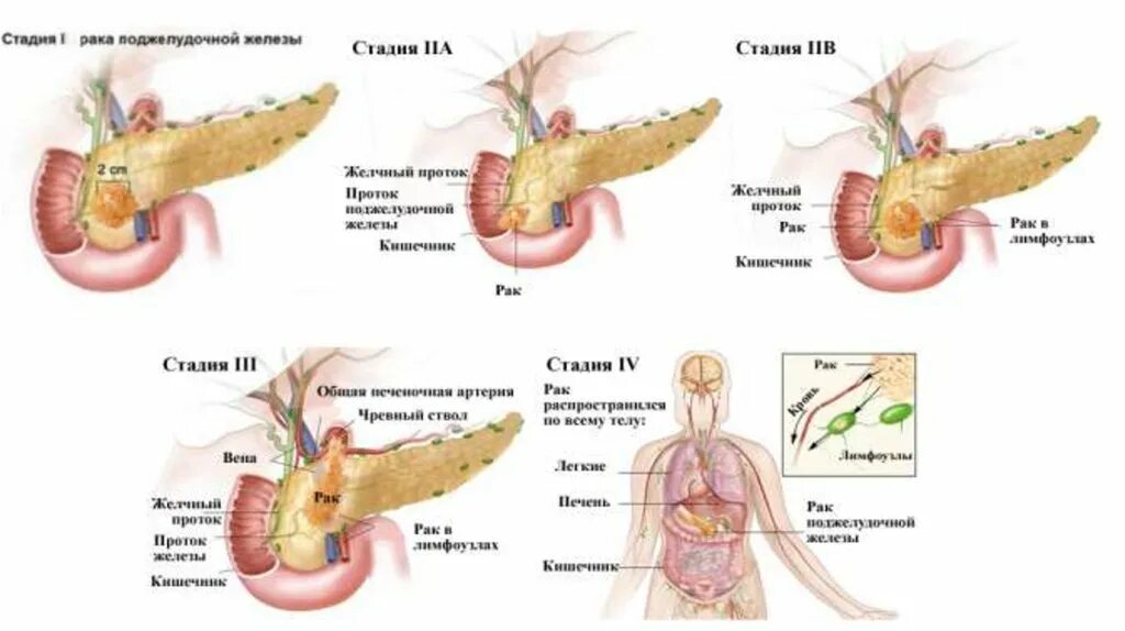 4 стадия поджелудочной железы сколько живут. Онкопатологии поджелудочной железы. Раковая опухоль поджелудочной железы. Опухоль головки поджелудочной железы синдром. Стадии опухоли головки поджелудочной железы.
