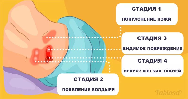 Памятка для родственников пациента. Памятка по профилактике пролежней. Памятка для пациента по профилактике пролежней. Памятка на тему профилактика пролежней.