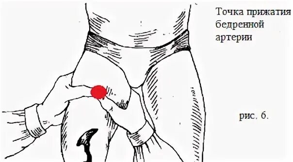Паховая складка у мужчин. Пальцевое прижатие бедренной артерии при кровотечении. Пальцевое прижатие сосудов бедра. Пальцевое прижатие сосудов бедренная артерия. Прижатие бедренной артерии пальцевое прижатие.