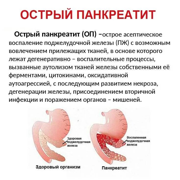 Может ли быть температура при поджелудочной железе. Острый панкреатит поджелудочной железы. симптомы проявления острого панкреатита. болезнь хронический панкреатит поджелудочной железы. острый панкреатит основные синдромы.