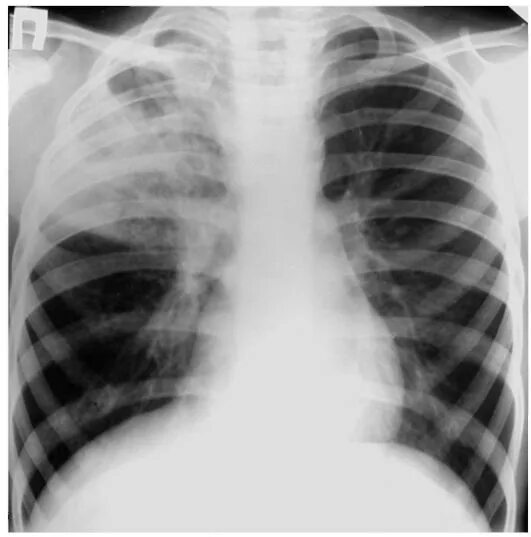 очаговая пневмония нижней доли правого легкого рентген. пневмония верхней доли левого легкого рентген. пневмония верхней доли рентген. пневмония верхней доли у ребенка. нижнедолевая очаговая пневмония рентген.