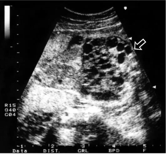 Узи аномалий. Поликистоз почек у плода на УЗИ. Мультикистоз почки у плода. Пороки развития плода на УЗИ.
