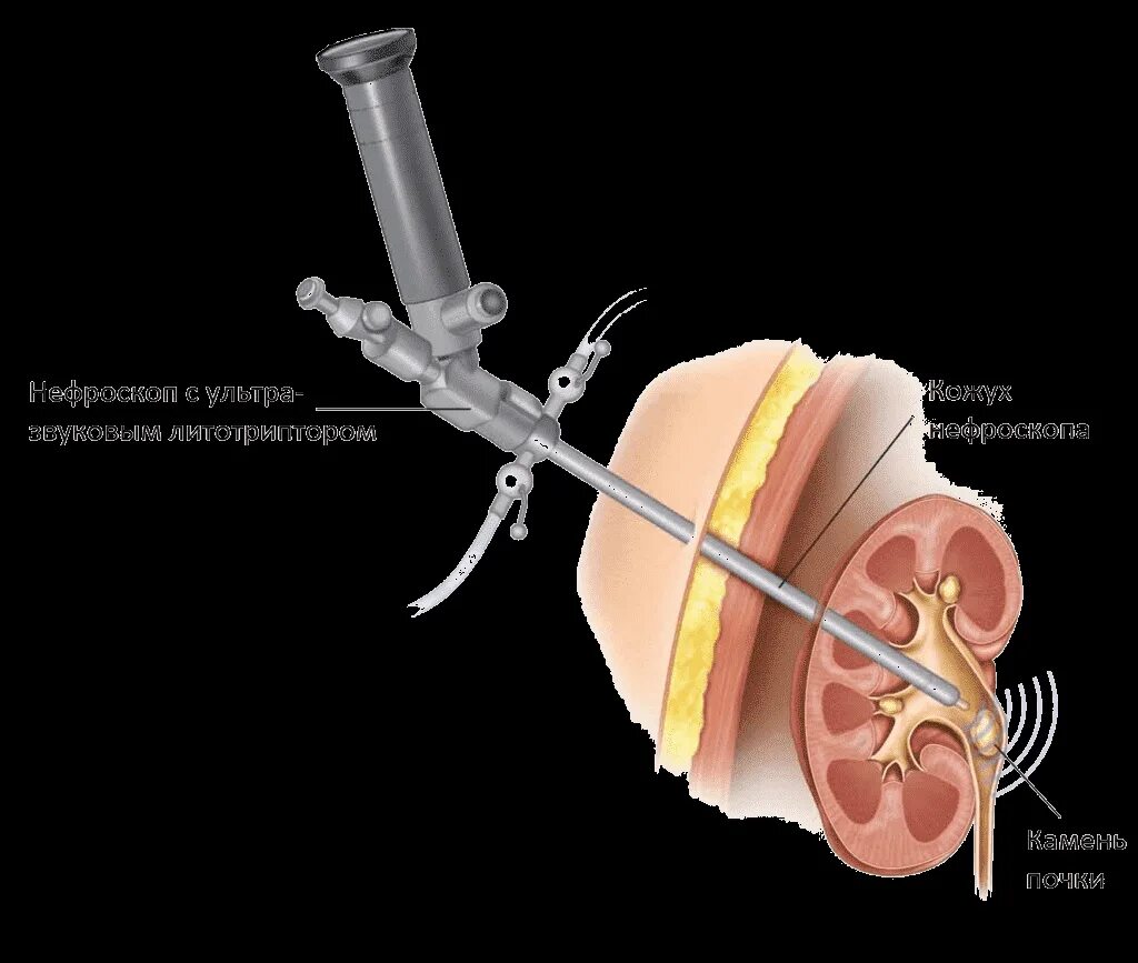Как выводить камень из мочеточника. Контактная литотрипсия камней мочевого пузыря, мочеточника. Трансуретральная литотрипсия. Трансуретральная контактная литотрипсия. Чрескожная ударно-волновая литотрипсия.