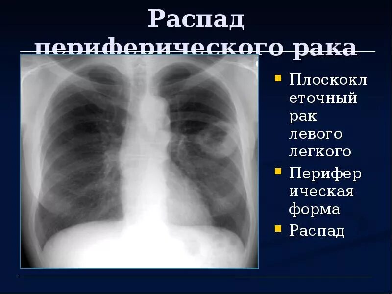 Распад органов. Опухоль легкого с распадом. Периферическое образование легкого рентген. Опухоль с распадом на рентгене. Распад опухоли в легком.