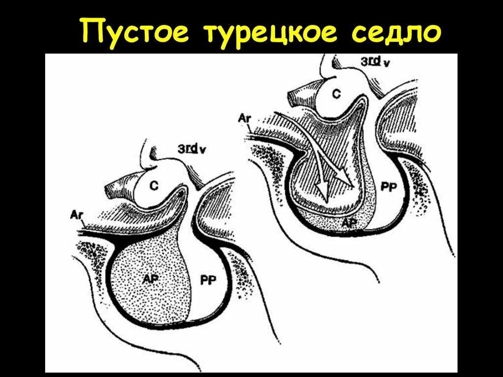 Симптом турецкого седла. Синдром пустого турецкого седла. Синдром пустого турецкого седла кт. Пустое турецкое седло. Гипофиз седло.