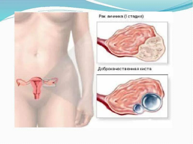 Как лечить дисфункцию яичников