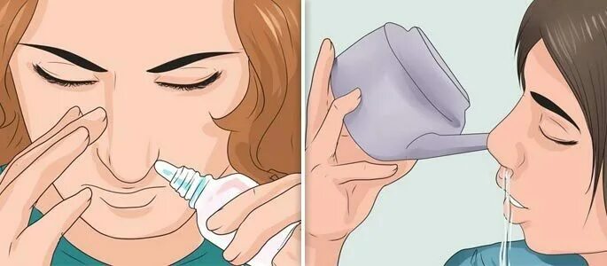 Техника промывания носа. Солевой раствор для промывания носа. Промывании полости носа солевыми растворами. Промывание носа от гайморита.