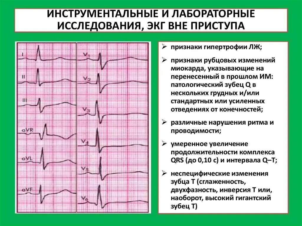 ЭКГ при метаболических изменениях миокарда. ЭКГ инфаркт миокарда, рубцовые изменения. Признаки изменения миокарда на ЭКГ. ЭКГ при ИБС И гипертрофии левого желудочка.