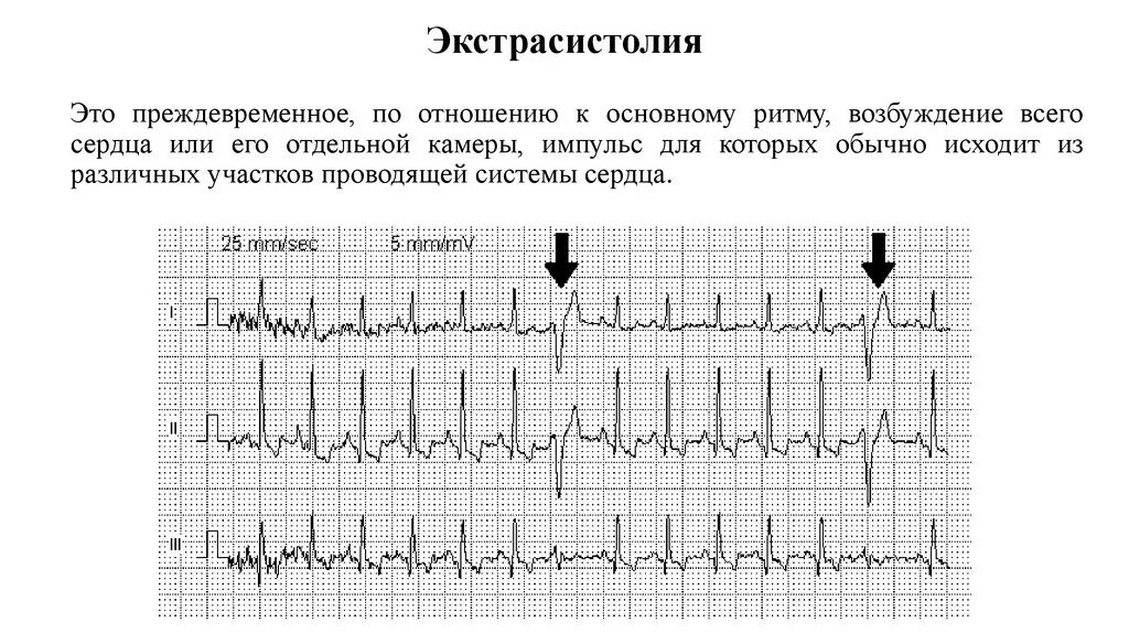 Экстрасистолия сердца симптомы и лечение у взрослых. Экстрасистолия на экг. аритмия экстрасистолия. ритм при экстрасистолии. предсердная экстрасистолия на экг.