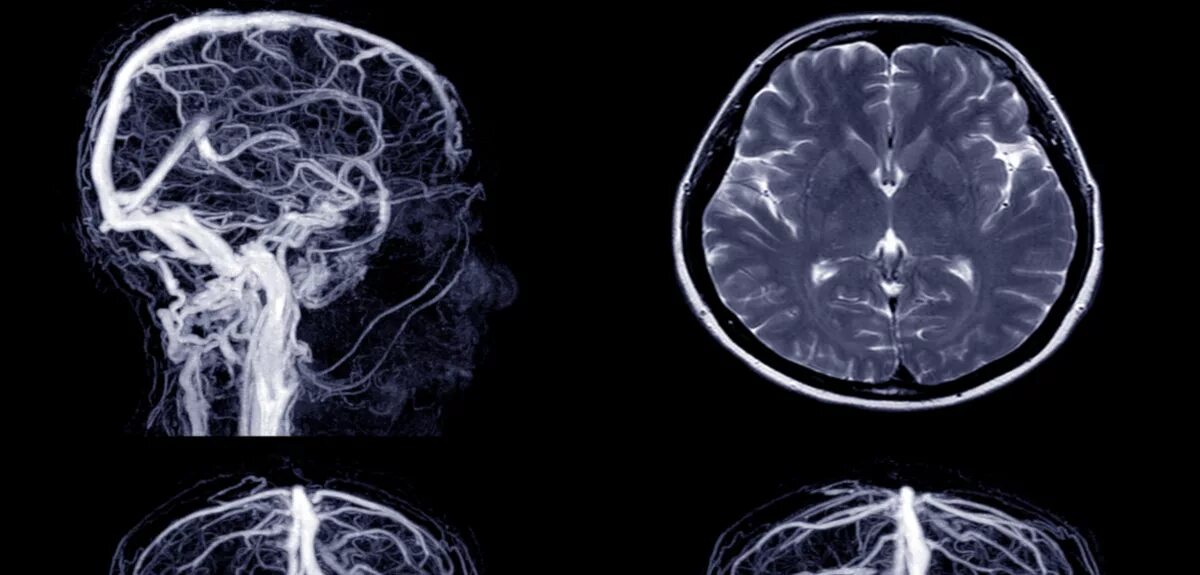 Венография головного мозга. Ангиография и венография головного мозга что это. Магнитно-резонансная венография головного мозга. Венография головного мозга анатомия.