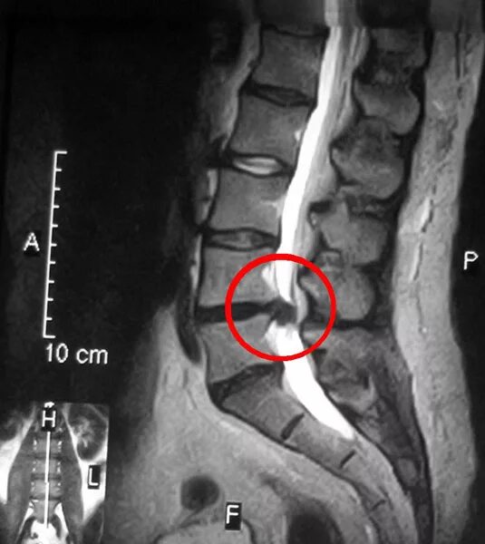 Крестцовый стеноз. Диски l5-s1 в позвоночнике. Грыжа дисков l5-s1. Дисков l4-s1 отдела позвоночника. Позвоночная грыжа l5 s1.