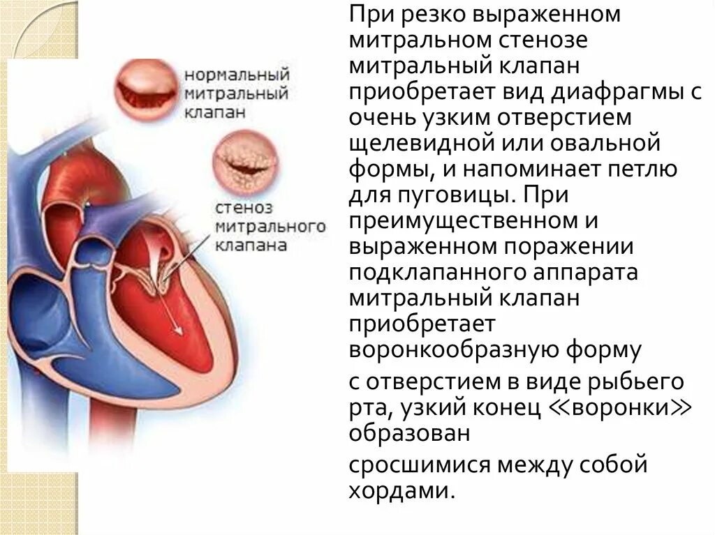 Митральный стеноз признаки. Стеноз митрального клапана симптомы. Стеноз митрального клапана проявляется:. Стеноз митрального клапана клиника. Клиника стеноза и недостаточности митрального клапана.