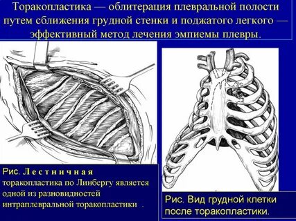 Торакопластика