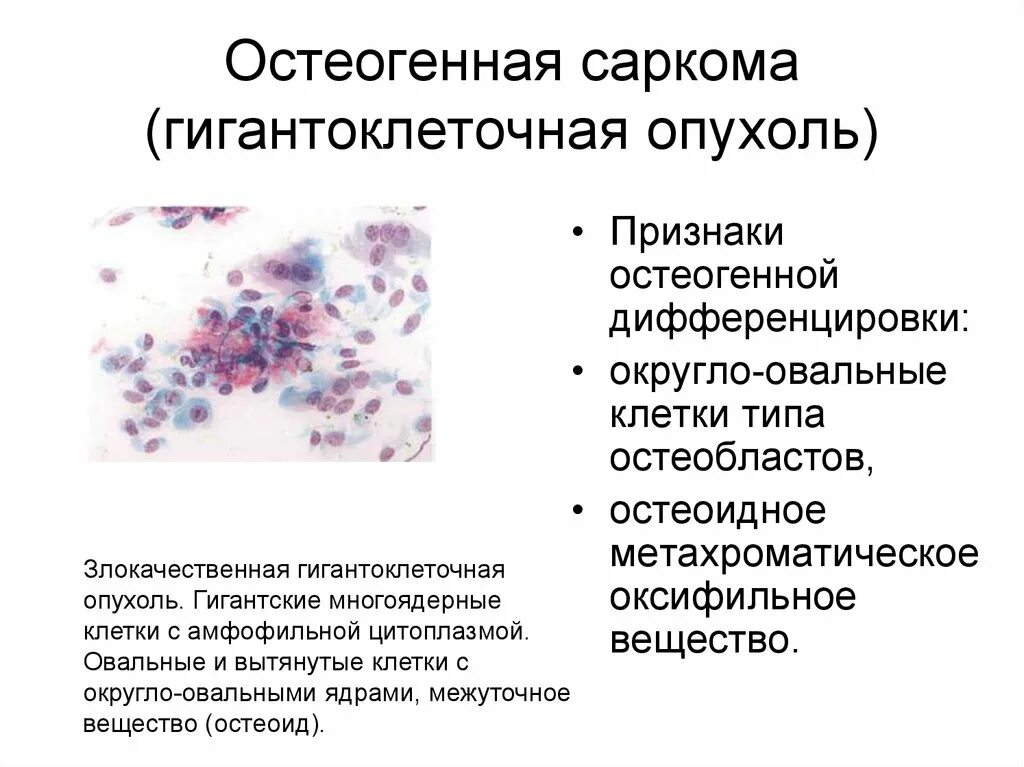 Степени саркомы. Цитологическое картина саркомы мягких тканей. Злокачественные новообразования. Гигантно клеточный опухоль.