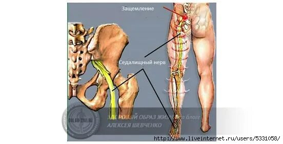 Можно ли греть при защемлении. Акупрессура седалищный нерв. Защемление седалищного нерва. Седалищный нерв расположен. Точечный массаж седалищного нерва.