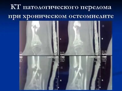 Застарелый перелом