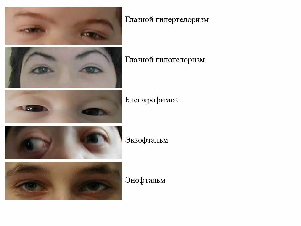 Врожденный блефарофимоз. Врожденный блефарофимоз. Врожденное сужение глазной щели. Врожденный блефарофимоз. Блефарофимоз.