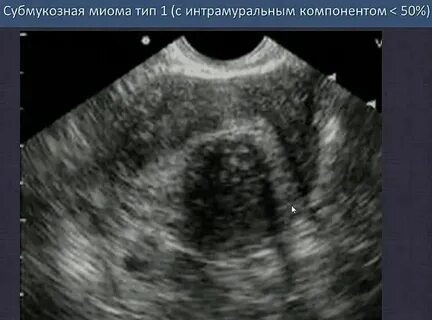 Узел в матке отзывы