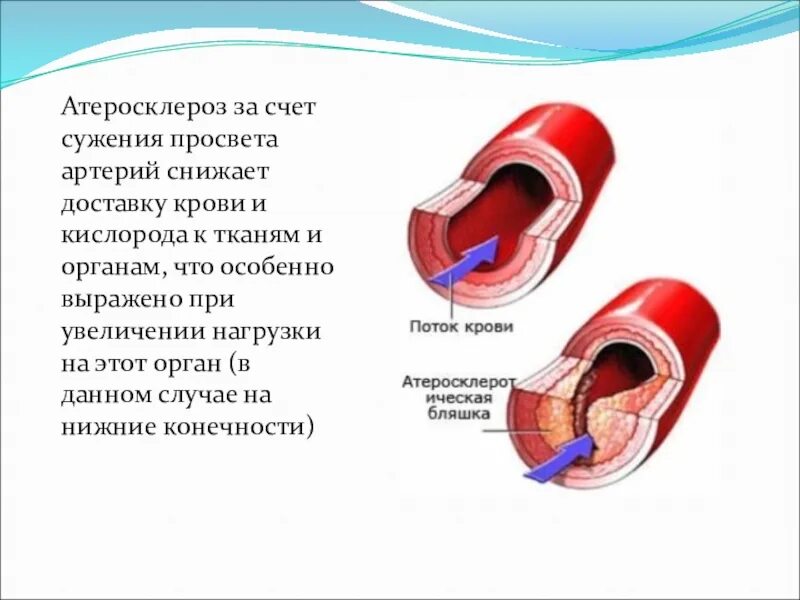 Стеноз просвета сосудов норма. Атеросклероз артерии просвет сосуда. Сужение просвета артерии.