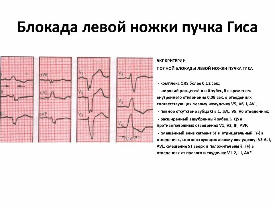 Изменение комплекса qrs