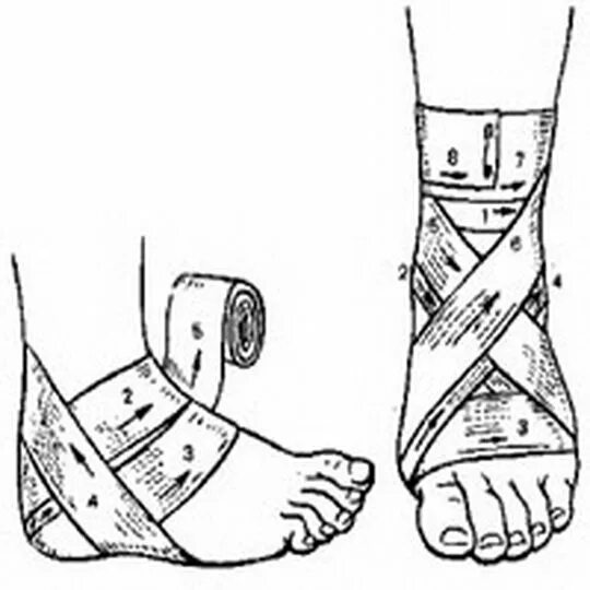 Схема бинтования коленного сустава эластичным бинтом. Бинтование травм голеностопа. Правильное бинтование колена эластичным бинтом. Десмургия повязка восьмиобразная на голеностопный сустав. Как перебинтовать эластичным
