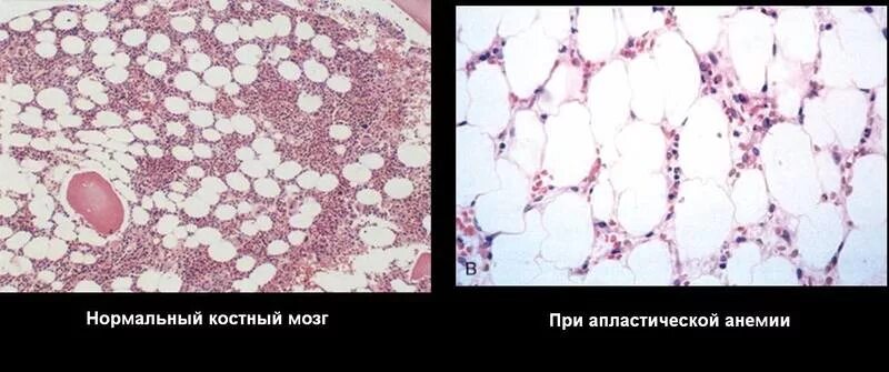 Метаплас тическая анемия. Метаплатическая анемия. Апластическая анемия гистология. Картина костного мозга при апластической анемии. Апластическая анемия красный костный мозг.