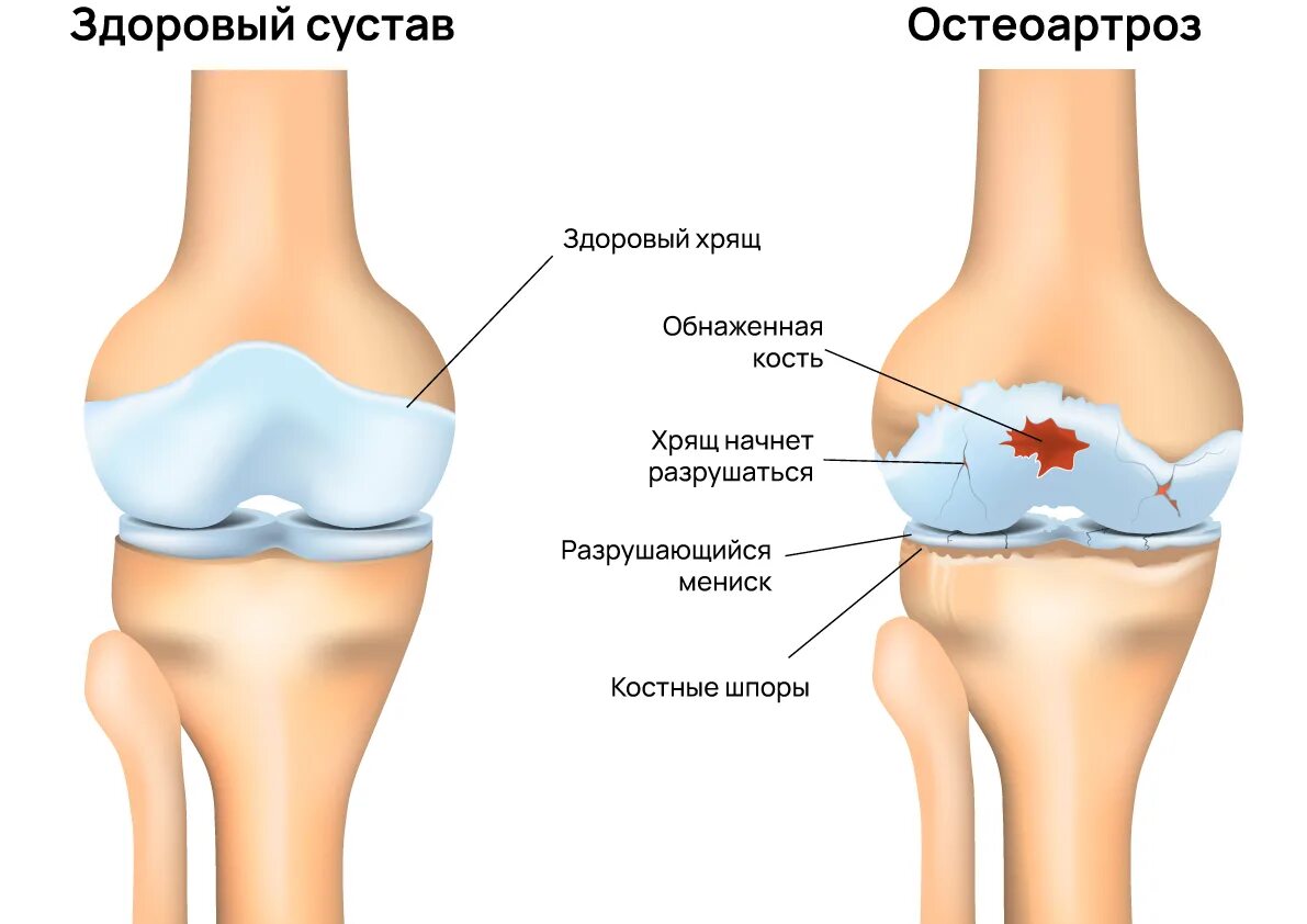 Гонартроз коленного сустава 1 степени симптомы. .деформирующий остеоартрит остеоартроз. гонартроз остеоартроз. деформирующий остеоартроз коленного сустава степени. гонартроз коленного сустава 2.