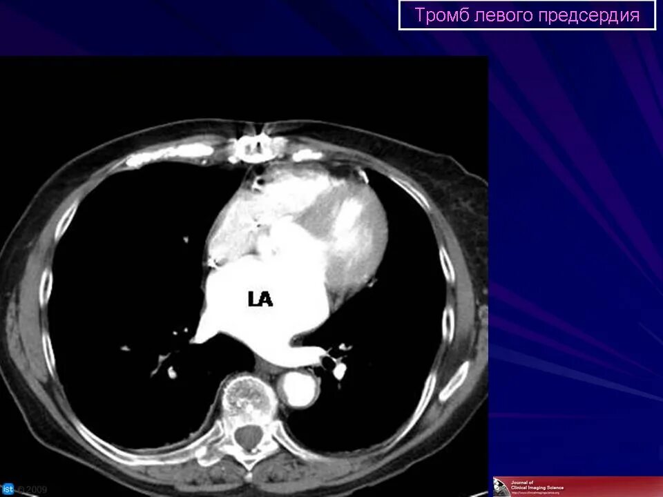 Тромбоз ушка левого предсердия кт. Аневризма левого предсердия кт. Аневризма предсердия кт. Тромб в ушке левого предсердия кт. Тромб в желудочке