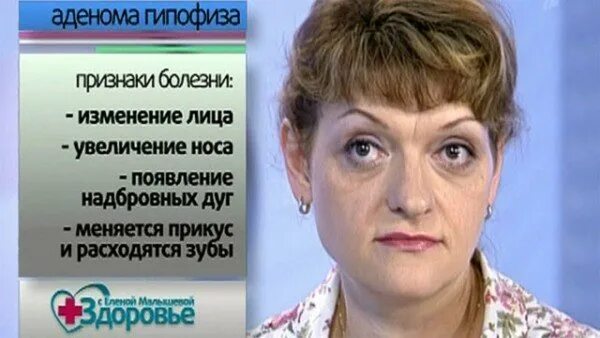 Гипофиза симптомы у женщин лечение прогноз. Симптомы аденом гепофеза. аденома гипофиза симптомы. аденома гипофиза фото женщины. опухоль гипофиза симптомы.