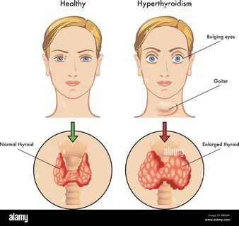 Thyroid gland illustration High Resolution Stock Photography and Images - Alamy