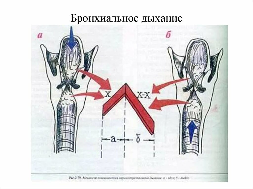 Бронхиальное дыхание. Бронхиальное дыхание механизм образования. Амфорическое бронхиальное дыхание. Патологическое бронхиальное дыхание механизм.