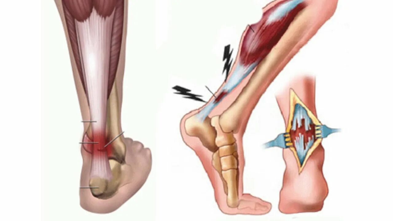 Разрыв ахиллова сухожилия голеностопного сустава. Разрыв сухожилия Ахилла. Тендинит воспаление ахиллова сухожилия симптомы. Трещина связке
