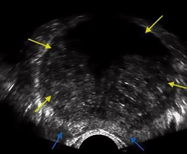 Трансректальное УЗИ предстательной железы. УЗИ трузи предстательной железы. Трансректальное УЗИ предстательной железы (+УЗИ мочевого пузыря. Трузи (трансректальное ультразвуковое исследование). Трузи предстательной железы как делают