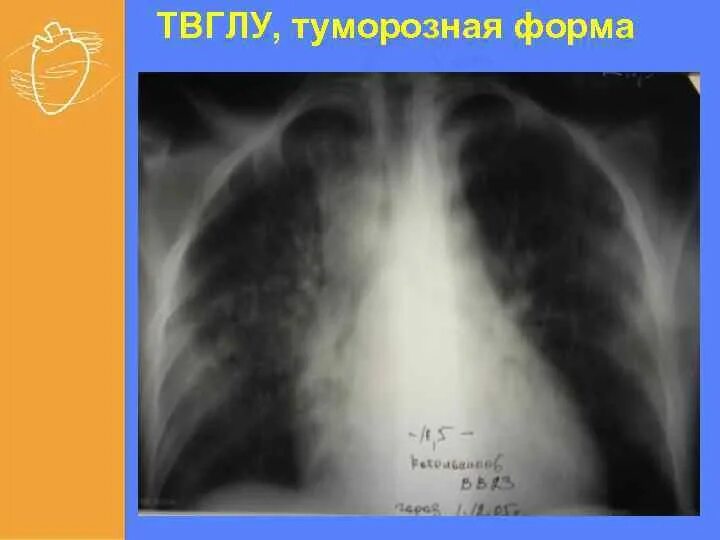 Бронхоаденит это. Туморозная форма туберкулеза рентген. туморозный бронхоаденит. туморозный туберкулез рентген. туморозный бронхоаденит туберкулез лимфоузлов.