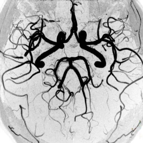 Гипоплазия правой артерии головного мозга. Артерии мозга Виллизиев круг. Виллизиев круг мрт. Виллизиев круг в головном мозге анатомия. Сосуды виллизиевого круга мрт.