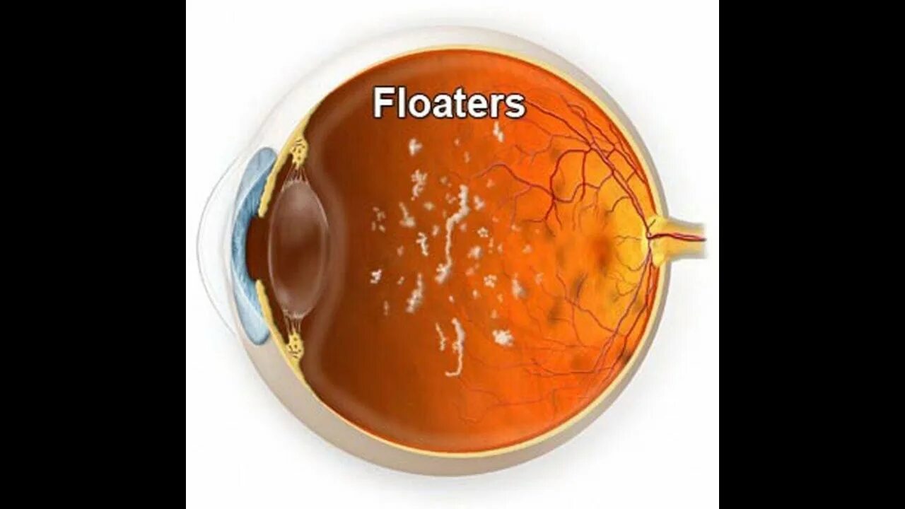 Деструкция стекловидного. Нитевидная деструкция стекловидного тела. Плавающие помутнения в стекловидном теле. Вытекание стекловидного тела. Прозрачное тело в глазу