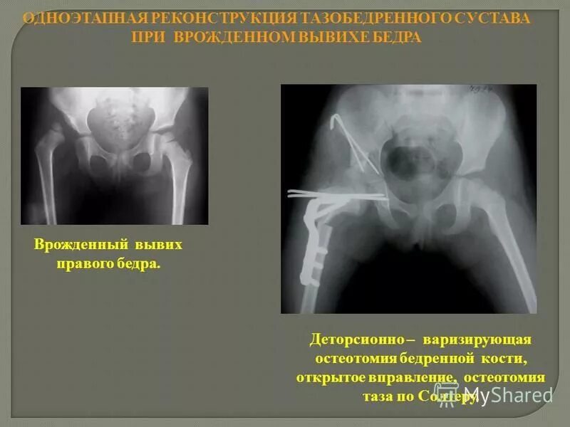 вывихи тазобедренного сустава классификация. оперативное лечение врожденного вывиха бедра. оперативное лечение врожденного вывиха бедра. врожденный вывих бедра операция. врожденный вывих бедра операция.
