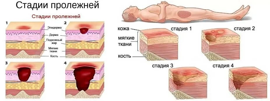 Пролежни 4 степени на человеке. 4 Пролежни профилактика пролежней. Стадии пролежней 2 степени. Пролежни на ягодицах у лежачих больных. Гнойный сестра