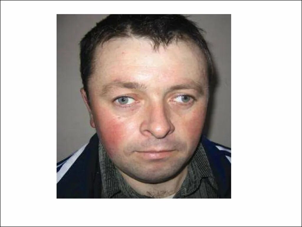 птоз,косоглазие сходящееся. сильное косоглазие. паралитическое косоглазие. глаза в разыеке стороны. николь потуральски косоглазие.