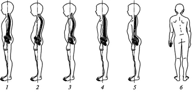 Сколиоз во фронтальной плоскости. Асимметрия осанки и сколиотическая осанка. Сколиотическая асимметричная осанка упражнения. Виды нарушения осанки в сагиттальной плоскости.