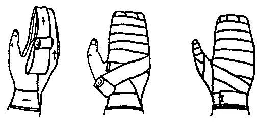 Повязка на кисть алгоритм. Техника наложения повязки варежка. Повязка варежка на кисть техника наложения. Перевязка варежка алгоритм. Десмургия повязка варежка алгоритм.