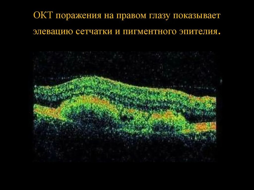 Окт диска зрительного нерва норма. Окт обеих глаз что это. Оптическая когерентная томография сетчатки. Оптическая когерентная томография сетчатки (окт). Окт макулярной зоны.
