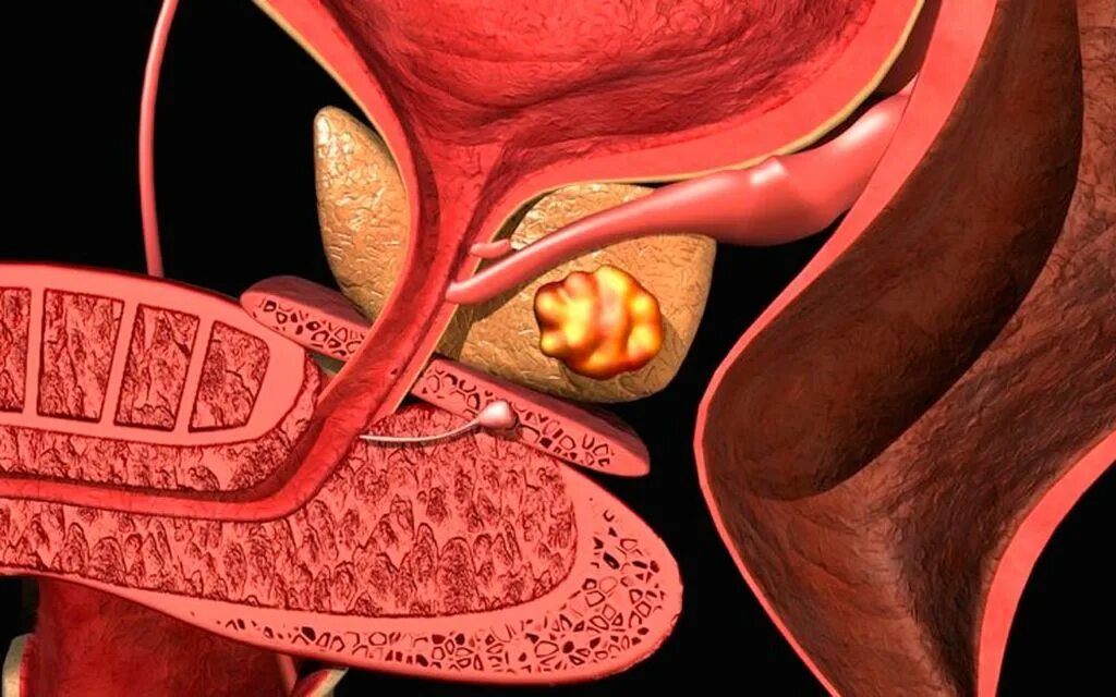 Хронический простатит аденома